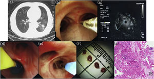 Details of transbronchial lung cryobiopsy (TBLC) guided by radial endobronchial ultrasound (r-EBUS).(a) Computed tomography (CT) scan of the chest showing a solitary pulmonary nodule located in the left lower lobe; (b) The placement of the r-EBUS probe into the target bronchus; (c) r-EBUS imaging showing a concentric lesion with no significant surrounding vessels; (d) An endobronchial blocker is placed in the proximal lobar bronchus from the lesion and is inflated after procedure; (e) The placement of the cryo-probe into the target bronchus; (f) Bioptic specimens with sizing scale collected through TBLC; (g) Immunohistochemical analysis revealing lung adenocarcinoma.