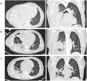 A. Admission lung CT: extensive lung consolidation of the superior and inferior right lobes and large loculated pleural effusion; B. Day 7 lung CT (after chest drainage insertion):large heterogeneous lung consolidation with air bronchogram and gas-filled cavities predominantly in the apical and posterior basal segments of the lower right lobe; C. Day 22 lung CT (after chest drainage repositioning and removal): improvement of lung consolidation extension and pleural effusion, with 16 days of linezolid.