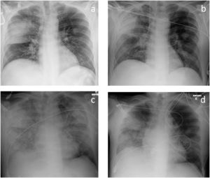 Chest radiographs at admission (a), on the 13th day of hospitalization (b), after the onset of TRALI (c) and after treatment for TRALI was started (d).