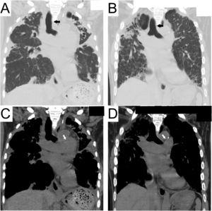 Chest computed tomography scan at the onset of vocal cord palsy. Coronal view of the tracheal bifurcation level. Pulmonary (A) and mediastinal (C) windows in Case #1 and Case #2 (B, D). Rightward deviation of the trachea (black arrows) caused by fibrosis and contraction of the upper lobe is shown (A, B). The aortic arch and pulmonary artery are in close contact (white arrows) with the tracheobronchial and mediastinal deviations (C, D).