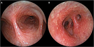 Bronchoscopic view displaying inflammatory mucosa with nodules in the carina, main bronchi, and right tracheal bronchus (A) and the right lower lobe bronchus (B).