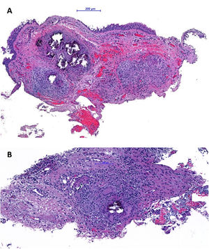 Haematoxylin and eosin stain of an endobronchial biopsy demonstrating respiratory-type mucosa with chronic inflammatory process with non-necrotizing granulomas (A) and multinucleated giant cells and calcifications.