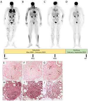 Patient evolution before and after JAKi (Tofacitinib) and mTOR inhibitor (Sirolimus). Evolution of fluorodeoxyglucose (FDG) Positron Emission Tomography (PET) before (A) and after JAKi (Tofacitinib) for 21 months with a complete thoracic, skin, bone, and splenic response (B), or 30 months with a node, skin, lung and splenic relapse (C) or mTOR inhibitor (Sirolimus) for 7 months with a complete multi-organ response (D) after JAKi arrest. P-STAT1 (E), P-STAT3 (F), PSTAT5 (G), P- mTOR (H), P-4E-BP1 (I) and P-P70S6 kinase (J) expression were assayed by immunohistochemistry in serial sections of an archived skin biopsy from the sarcoidosis patient. mTORC1 phosphorylates downstream p70S6 Kinase 1 and modulates the eukaryotic initiation factor 4E-binding protein (4E-BP1), both promoting several cellular processes such as cell proliferation, activation, and survival.