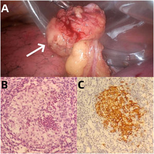 Surgically removed tissue (arrow, A). Hematoxylin and eosin-stained images showed tumor cell nuclei of renal or coffee bean shape with complex folded nuclear membranes and obvious nucleoli, accompanied by a large number of eosinophilic infiltration(B). Immunohistochemical staining showed that Langerhans' tissue cells express CD1a(C).