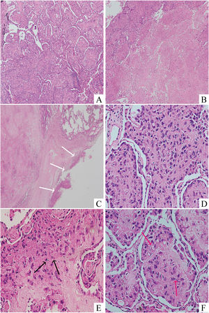 Histological examination of the lesion revealed the eosinophilic epithelioid tumour cells grew within (A) the alveolar space (Hematoxylin and eosin stain, 100 ×) with (B) significant necrosis (Hematoxylin and eosin stain, 100 ×) and (C) focal parietal pleural invasion (Hematoxylin and eosin stain, 40 ×) (white arrow). The neoplastic cells exhibited (D) marked nuclear pleomorphism (Hematoxylin and eosin stain, 400 ×) and (E) numerous mitotic figures (5 mitoses per 10 high-power fields; Hematoxylin and eosin stain, 400 ×) (black arrow). (F) Intracellular vacuolisation and intracellular erythrocytes (red arrow), which represented primitive vascular lumens, were observed (Hematoxylin and eosin stain, 400 ×).(For interpretation of the references to color in this figure legend, the reader is referred to the web version of this article.)