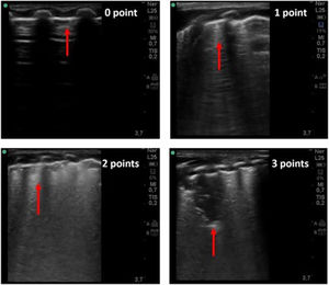 Lung ultrasound imaging related to LUS score (0–3). Score 0: normal A-lines with a continuous and regular pleural line. Score 1: multiple separated B-lines. Score 2: coalescent B-lines pattern with alterations of the pleural line.Score 3: consolidation area and possibly a large white lung artefact.