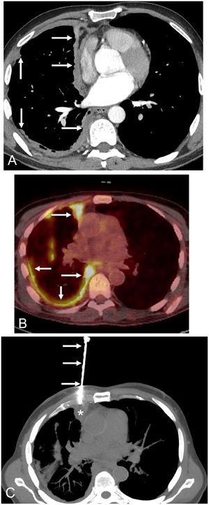 A) Axial thoracic CT image (mediastinal window) shows a solid nodular thickening (arrows) of the right hemithorax pleural surface that particularly involves the mediastinal pleura. B) Axial fused thoracic PET/CT image demonstrates an intense FDG uptake by the nodular pleural thickening (arrows). C) Axial chest CT image (mediastinal window) shows the biopsy needle (arrows) targeting the nodular pleural surface (asterisk).