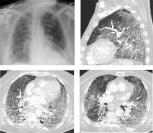 Chest X-ray (A) and chest CT (B,C,D) during hospitalization. Bilateral consolidative pneumonia with ground glass opacities shown on sagital plane (B) and axial plane (C,D).