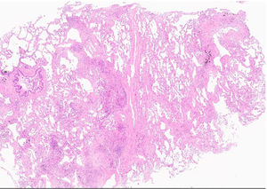 Transbronchial cryobiopsy. The patchy fibrosis and scattered fibroblastic foci are evident along an interlobular septum (star) sparing the centrilobular region. Only one tongue of fibrotic tissue is “running” towards a bronchiole (triangle), The fibrotic process has an “arc-like” shape (line). (H&E,low power).