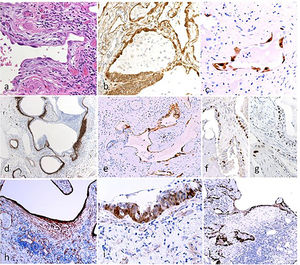 Histological and immunohistochemical analysis in UIP. Hyperplastic AECII cover densely the fibrotic interstititial tissue in the early alveolar lesions (a). AECII show nuclear beta-catenin (b) and the senescence-associated marker p16 (c). Honeycomb cyst: a continuous layer of early-fibrous tissue underlying the epithelial surface as demonstrated by tenascin (d) is covered by p16+ senescent epithelium (e). Basal cells in Honeycomb cyst show irregular distribution (f, DN-p63) and a senescent phenotype (g: p21). TBB3 clearly evidence both myofibroblasts and damaged epithelial cells (h). Basal express nuclear beta-catenin (i) and the WNT pathway target gene Cyclin-D1 (l).