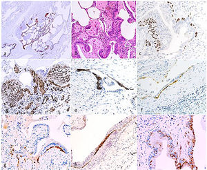 Micro-Honeycomb cysts: their aspect is characterized by “modified bronchioles” characterised by severely altered epithelial structure, fragmentation and disorganisation of the epithelial component as evidenced at CK5 immunostain for basal cells (a). The airway structure is severely compromised, with luminal epithelial cells fragmentation (b, H&E), loss of ciliated epithelium, and aphazard distribution of DN-p63+ basal cells (c). Nodular/elissoid alpha-SMA+ interstitial myofibroblast foci are common, occurring in segments of severe structural changes of the airway epithelium (d). These foci, previously described and named “Sandwich Foci” (SF) [Chilosi 2006;2013], are three-layered lesions formed by a CK5+ layer of basal/oid abnormal cells (e) interposed between superficial bronchiolar epithelial cells (often non-ciliated as evidence of bnormal differentiation) and the aSMA+ clusters of myofibroblasts (c). The basal/oid cells’ phenotype include the expression of molecules related to migratory activity as laminin-5-gamma-2 (f) and heath-shock protein-27 (g,h) as well as cell senescence (p16, i). These SF, that are fairly specific for the UIP pattern, may recapitulate major pathogenic mechanisms occurring in micro-Honeycomb cyst formation, and may also represent useful “biomarkers” in small cryobiopsy samples.