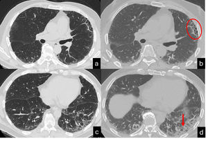 Inspiratory (a,c) and espiratory CT scan (b,d) shows UIP pattern characterized by the presence of honeycombing in the anterior segment of the left upper lobe, traction bronchiectasis and focal fibrotic ground glass in the left lower lobe. A mild peripheral reticulation is also present in the right lung parenchyma. The expiratory scan (b,c) shows a homogenous reduction in lung volumes associated with a diffuse increase of the lung density, in absence of air trapping. Interestingly, the area of honeycombing doesn