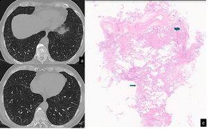 CT scan (a,b) shows reticulation associated with mild architectura lobular distortion, visible in the peripheral lung. This finding assumes an «arciform aspect» beneath the pleura (yellow arrow) and a poligogonal shape in the inner parenchyma (yellow circle). Scattered pulmonary ossifications are also present bilaterally. Cryobiopsy (c): the interlobular septum (star) and the centrilobular zone (arrow) are identifiable. A tongue of fibrotic tissue with an arc-like shape connects these two anatomic zones (H&E, low power).