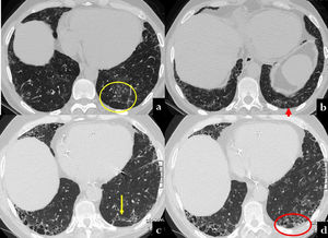 CT scan at baseline (a,b) and twelve years later (b,c) in a 70 year old male, with history of polymiositis and dermatomyositis. In the first CT, scattered nodular ground glass opacities are present in both lower lobes (a). Moreover, some linear opacities with an arciform aspect are visible beneath the pleura, mainly in the left lobe (a, yellow circle; b, red arrow). After twelve years, the patient showed UIP patern characterized by ttraction bronchiectasis and honeycombing along the arciform lesion of the prior exam (c, yellow circle; d, red circle).