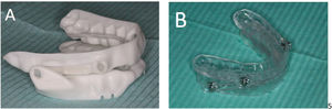 Example of adjustable mandibular advancement devices: Narval CC device, Resmed (A); BTI DIA device (B).