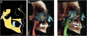Schematic diagram of the working mechanism of a mandibular advance dispositive (MAD) (A) advancement and forward positioning of the mandible during sleep. (B) Corresponding upper airway volumes in relation to the anatomical structures without (left panel) and with (right panel) mandibular advancement.
