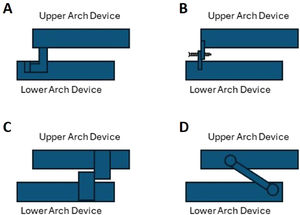 Schematic overview of titratable, duo-bloc MAD designs used in current clinical practice: (A) MAD with an anteriorly articulating component that allows the MAD for adjustment of the appliance; (B) MAD with attachments for adjustment of mandibular protrusion in the frontal teeth area; (C) MAD with two lateral positioning attachments that permit incremental protrusion of the mandible; (D) MAD with lateral telescopic rods that force the mandible into an anterior position.