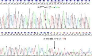 (A) DNA sequence chromatogram showing HbDIran mutation on 22 codon (GAA>CAG). (B) DNA sequence chromatogram showing β0 thal {4 bp del Cds 41/42 (-CTTT)}