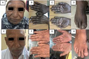 A–D: Clinical photograph of the patient showing hyperpigmentation of skin involving face, hand and foot. E–H: Repeat clinical photograph of the patient showing near complete resolution of the hyperpigmentation of affected areas.