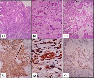 (A) Histologic features of the gastric biopsy: A1 – Gastric mucosa with extensive atypical lymphoid infiltration [hematoxylin and eosin (H&E) – 100×]; A2 – Diffuse reactivity for CD20 – 100×; (B) Histologic features of colon polyps: B1 – Granular cell tumor (H&E – 400×); B2 - Strong and diffuse reactivity for S100 – 400×; (C) Histologic features of lung lesions: C1 – Lung mucinous adenocarcinoma (H&E – 100×); C2 – Positive reactivity for TTF1 – 100×.