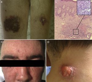(a) Lesions evolved to ulcers and cribriform scars; (b) dense neutrophilic infiltration of the dermis consistent with PG; (c) extensive acneiform lesions on the face giving a leonine appearance; and (d) new PG lesions.