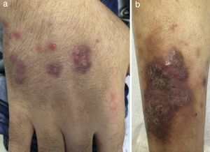 New nodular and erythematous cutaneous lesions consistent with EED.
