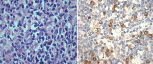 Bone marrow biopsy in acute lymphoblastic leukemia. Left: Hematoxylin and eosin stain (400×) sheets of lymphoblasts. Right: Immunohistochemical staining (400×) – receptor for hyaluronan-mediated motility (RHAMM)-positivity in cytoplasm of blasts.