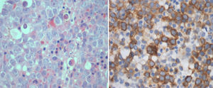 Bone marrow biopsy in acute myeloid leukemia. Left: Hematoxylin and eosin stain (400x) Sheets of Myeloblasts. Right: Immunohistochemical staining (400×) – receptor for hyaluronan-mediated motility (RHAMM)-positivity in cytoplasm of blasts.