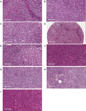 Pathological assessment of follicular lymphoma (FL) and mantle cell lymphoma (MCL). (A–C) Histological grading of FL: Grades 1 (A), 2 (B) and 3A (C) showing increasing percentages of centroblasts in comparison with centrocytes. (D–F) Patterns of MCL proliferation: nodular (D), mantle zone (E) and diffuse (F). (G–I) Cytological variants of MCL: classic (G), small cell (H) and blastoid (I).