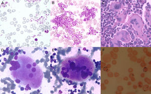 (A–F) A and B: Peripheral Blood Smear (leishman 400×): Macrocytosis (2+) of red blood cells and large platelet clumps; C: Bone marrow biopsy (hematoxylin and eosin 100×): Large megakaryocytes with hyperlobulated nuclei; D and E: Bone marrow aspirate (leishman 400×): Megakaryocytes with Stag-horn nuclei, dysplastic form with disjointed nuclei; F: Perl's stain oil immersion: ringed sideroblasts.