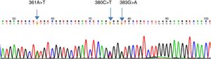 Result of the RHCE gene sequencing, with three polymorphisms compatible with the RHCE*cE.15.02/RHCE*ce genotype.