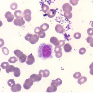 Wright–Giemsa stained smear of peripheral blood containing classic hairy cells - medium size lymphocytes with moderately abundant pale blue cytoplasm and a characteristic serrated cytoplasmic border.