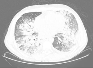 Thoracic computed tomography – bilateral pulmonary opacities in a “crazy paving” pattern compatible with severe acute respiratory distress syndrome.