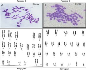 Karyotypic analysis of a representative stem cell isolated from human adipose tissue. (A) Karyotypic analysis of Passage 2 human adipose tissue-derived stem cells from a female donor with a normal female Karyotype (46, XX). (B) At Passage 5, human adipose tissue-derived stem cells from a male donor expressed normal a male karyotype (46, XY).