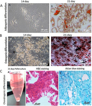 Trilineage differentiation potential of human adipose tissue-derived stem cells. (A) Phase contrast micrographs showing the different stages of differentiation of human adipose tissue-derived stem cells to adipocytes. Adipocytes with oil droplets are visible on Day 14 of adipogenic induction; the size and number increased as the differentiation progressed. Oil Red O stained the lipid droplets red on Day 21 (magnification 20×). (B) Phase contrast micrographs showing different stages of the differentiation of human adipose tissue-derived stem cells to osteoblasts. Day 14 of osteogenic induction showed visible mineral deposits. There was a significant increase in the mineralization on Day 21 of osteogenic induction (magnification 20×). (C) Pellet culture of human adipose tissue-derived stem cells on Day 21. Hematoxylin & eosin staining showed homogenous cell distribution. Alcian blue staining of acid showed mucopolysaccharide aggregates in the differentiated chondrocytes.