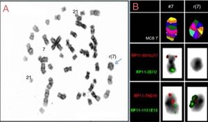 Cytogenetics. (A) Band showing partial karyotype. (B) Multicolor band of ring chromosome 7 and bacterial artificial chromosome probe showing the breakpoint and ring fusion region.