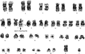 Conventional cytogenetics study of patient showing 46,XY,der(7)t(1;7)(q10;p10)[18]/46,XY[2].