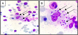 Leishmania amastigotes phagocytosed by macrophages. Black arrows show amastigotes (May-Grünwald stain; (A) magnification: 400×, (B) magnification: 1000×).