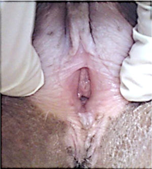 Vulvar lichen sclerosus due to graft-versus-host disease.