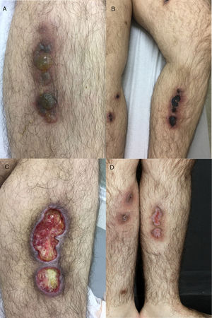 (A) Deep infiltrated lesions with tense blisters on the surface; (B) after starting therapy with acyclovir, lesions became necrotic and ulcerated covered with an adherent black eschar; (C) lesions evolved to extensive deep ulcerated areas; (D) three months after initiating therapy, almost complete healing with residual atrophic scars.
