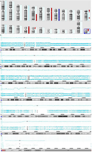 Genomic alterations detected by SNP array in case 1. a. Karyoview. b. Deletion in 5q21.1q35.3 (CN: 1.00). c. Deletion of one entire allele of chromosome 7 (CN: 1.00). d. Gain of one entire allele of chromosome 8 (CN: 3.00). e. Deletion in 12p13.33p12.3, 12p12.1p11.22 2 and 12q22q23.3 (CN: 1.00). f. Deletion of one entire allele of chromosome 16 (CN: 1.00). g. Mosaic loss in 17p13.3p11.2 (CN: 1.50). h. Loss of chromosome Y (CN: 0.00).