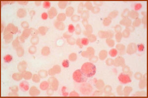 Ring sideroblasts in marrow smears.
