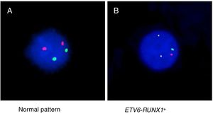 FISH using TEL/AML1 Translocation, Dual Fusion probe (spectrum orange/spectrum green) showing (A) the normal pattern (2 orange and 2 green signals) and (B) the ETV6-RUNX1 gene fusion (1 orange signal, 1 green signal and two co-localizations).