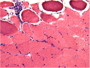 Vastus lateralis muscle biopsy demonstrating perimysial lymphocytic inflammation with adjacent hypereosinophilic (acutely necrotic) muscle fibers (hematoxylin and eosin stained section 200×).