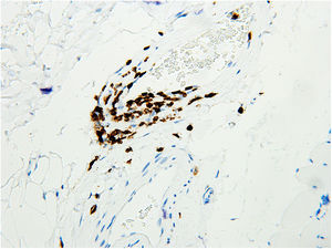 Immunohistochemical staining for T cells demonstrating lymphocytic infiltration of perimysial arterial wall (CD3 immunohistochemical staining 200×).