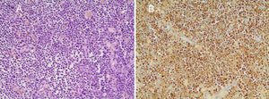 Histological confirmation of acute lymphoblastic leukemia, despite monoclonal antibody therapy. (A) The core-biopsy shows numerous small- to medium-sized lymphocytes among scattered hemosiderin-containing macrophages (Hematoxylin–Eosin, 200×). (B) The TdT expression by immunohistochemistry (200×).