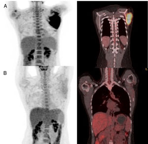 The 18FDG PET-scan of the patient after blinatumomab therapy (A) and after inotuzumab plus radiotherapy (B).