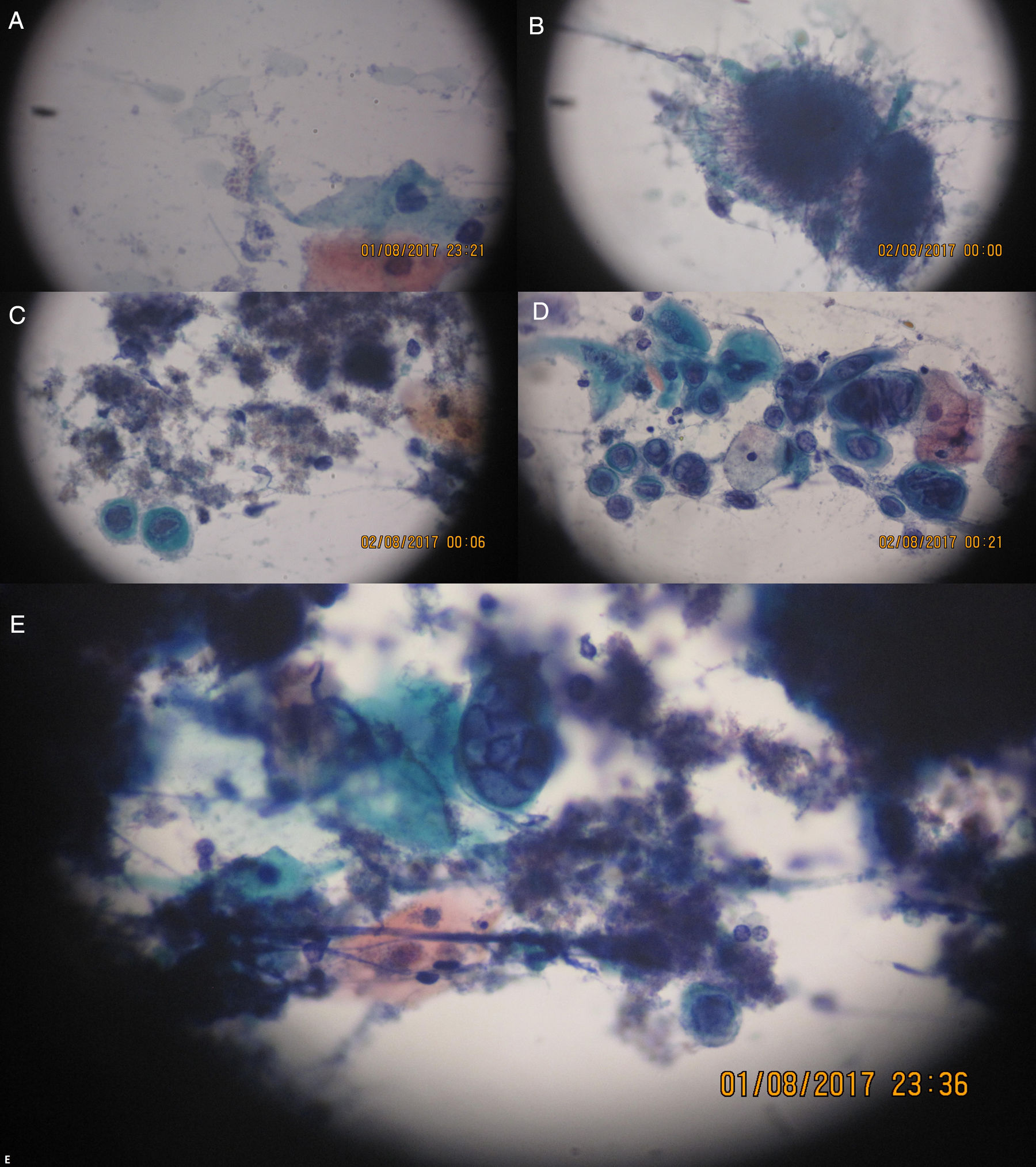 Polymicrobial infection of the oral mucosa after hematopoietic stem ...