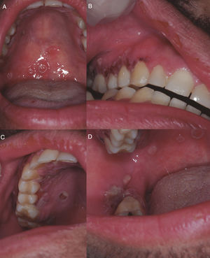 (A) Ulcers with irregular and raised borders on the soft palate. (B) Ulcers with irregular and raised borders on gingival margin and areas of erythema and increased gingival volume of fibrous consistency with areas of necrosis. (1) Ulcers with irregular and raised borders on hard palate and gingival margin. (D) Ulcers with irregular and raised borders on the right cheek mucosa.