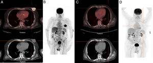 18F-FDG PET/CT baseline (A, B) and 18F-FDG PET/CT post treatment (C, D). Images showing area of increased radiopharmaceutical uptake located in the left breast on transaxial fused images (A) that disappears after four cycle of chemotherapy (C). B and D are baseline and post-treatment maximum intensity projection (MIP) PET images demonstrating complete metabolic response.